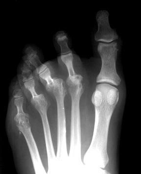 Rheumatoid arthritis - foot Depressed