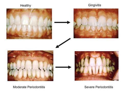 Periodontitis and RA are closely