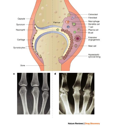 Rheumatoid arthritis cartilage and bone destruction Normal synovial layer: a thin membrane of loosely associated fibroblast- and macrophagelike mesenchymal cells lining the articular