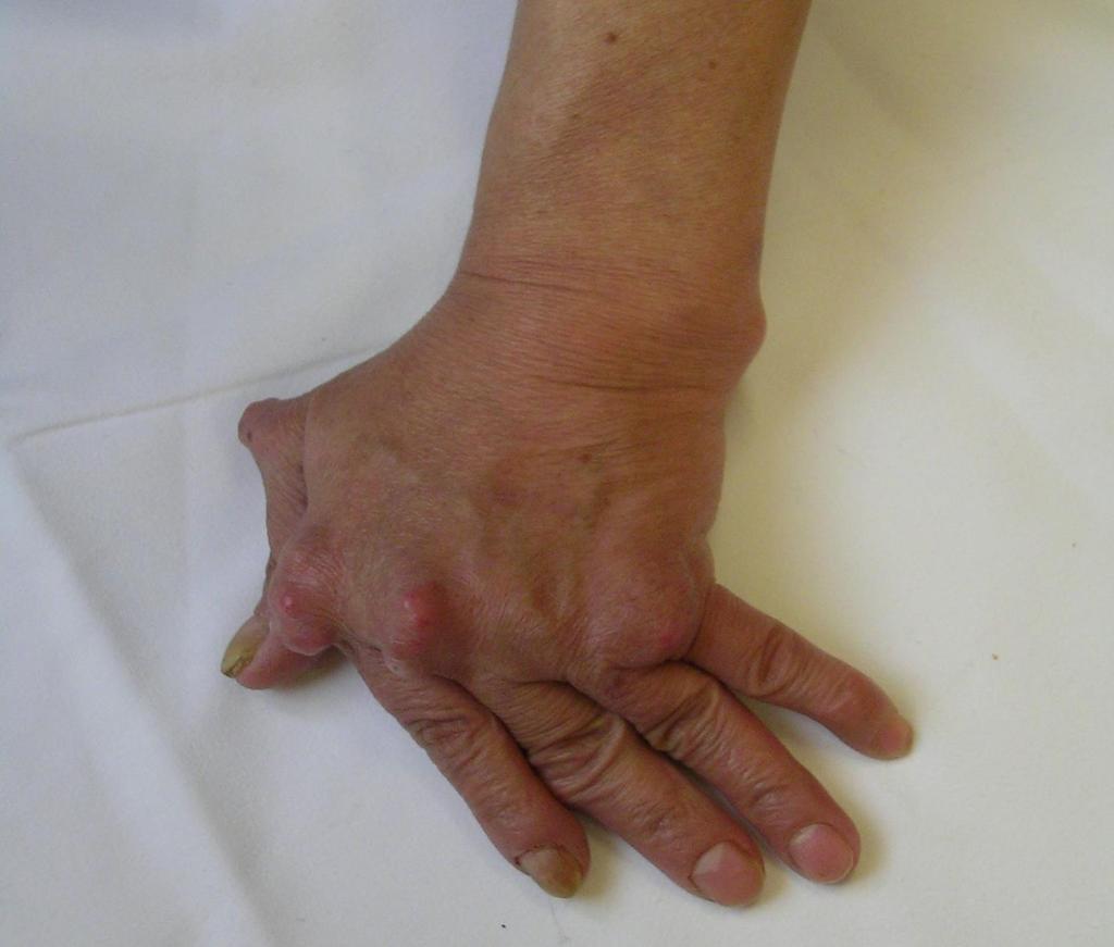 Longstanding RA Ulnar deviation of fingers Flexion contracture in the