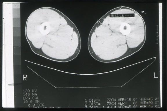 CT of thigh,