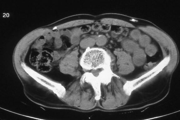 CT scan of abdomen, normal-weight male.