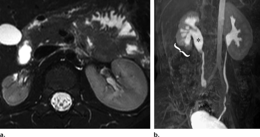 1218 July-August 2015 radiographics.rsna.org Figure 7. Imaging findings in a 5-year-old boy with right vesicoureteral reflux.