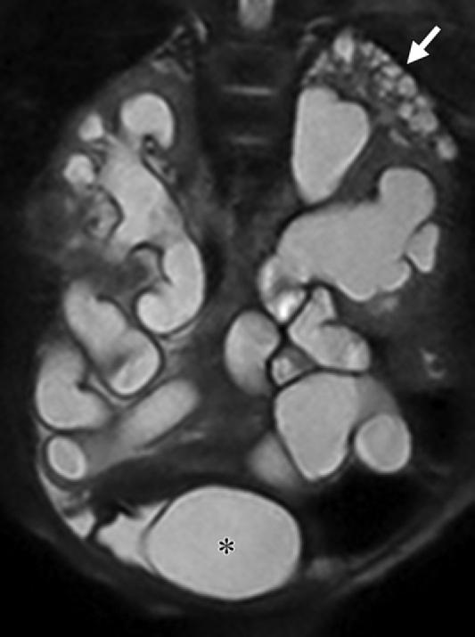 1220 July-August 2015 radiographics.rsna.org Figure 10.