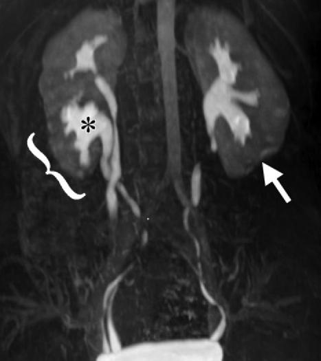 Imaging findings in a 13-year-old boy with recurrent right flank pain after a remote history of right high-grade renal injury; US (not shown) showed a right renal cystic structure of uncertain