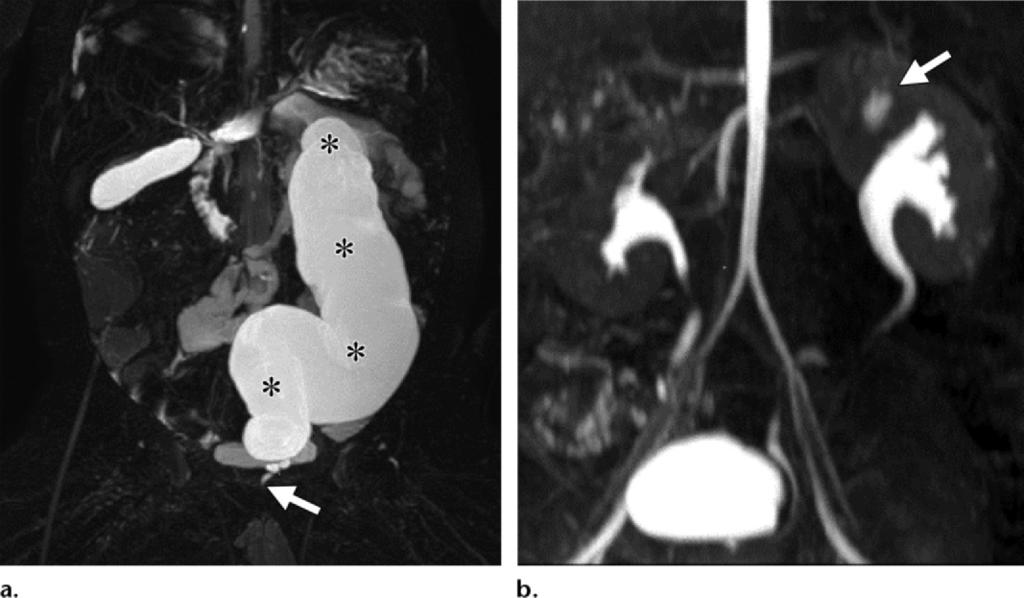 RG Volume 35 Number 4 Dickerson et al 1221 Figure 13. Imaging findings corresponding to the Weigert-Meyer rule in a 4-month-old boy with a duplex kidney.