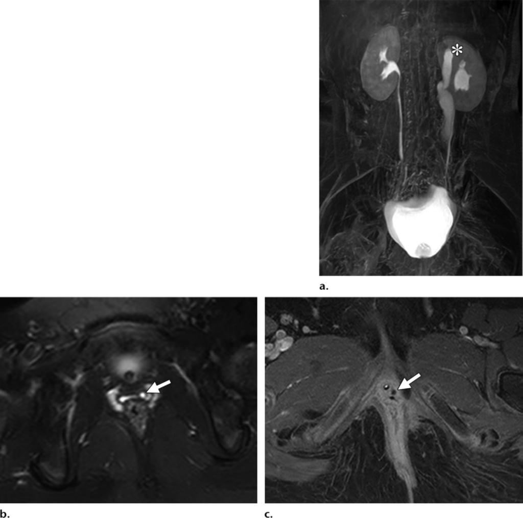 1222 July-August 2015 radiographics.rsna.org Figure 15. Imaging findings in a 7-year-old girl with daytime and nighttime wetness despite successful toilet training.