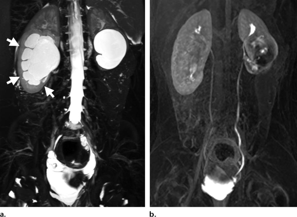 RG Volume 35 Number 4 Dickerson et al 1223 Figure 16. Imaging findings in an 8-year-old girl with bilateral hydronephrosis seen at US.