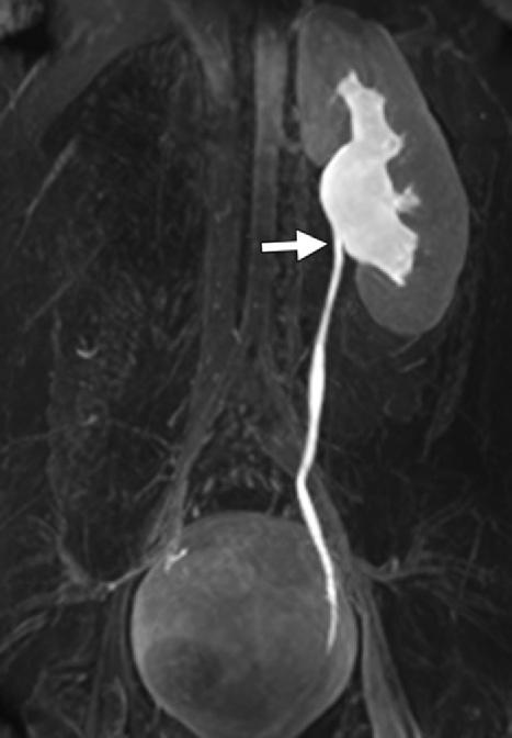 flank pain) shows a surgically reconstructed left ureteropelvic junction that is patent and without narrowing (arrow), normal left kidney parenchyma, and congenitally absent right kidney. Figure 20.