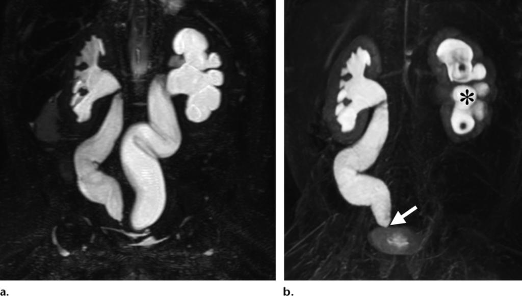 1226 July-August 2015 radiographics.rsna.org Figure 21. Imaging findings in a 5-month-old boy with bilateral obstructing congenital primary megaureters and normal voiding cystourethrography findings.