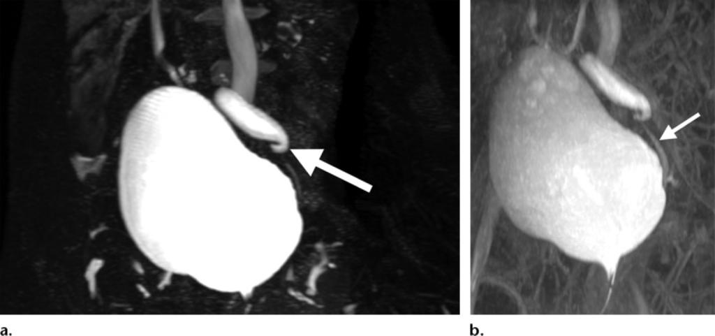 (b) Coronal delayed phase T1-weighted 3D spoiled gradient-recalled fat-saturated MIP MR urogram obtained 20 minutes after contrast material injection shows asymmetric excretion of contrast material,