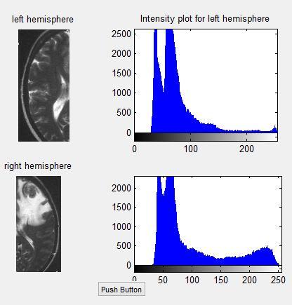 The final segmented image is then superimposed on the edge-boundary image which clearly distinguishes tumor images from non-tumor ones and the boundaries are detected.
