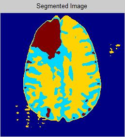 Edge detection methods Region growing methods Watershed segmentation Clustering segmentation The best suited segmentation technique is clustering method for brain MRI ned images; because, in other