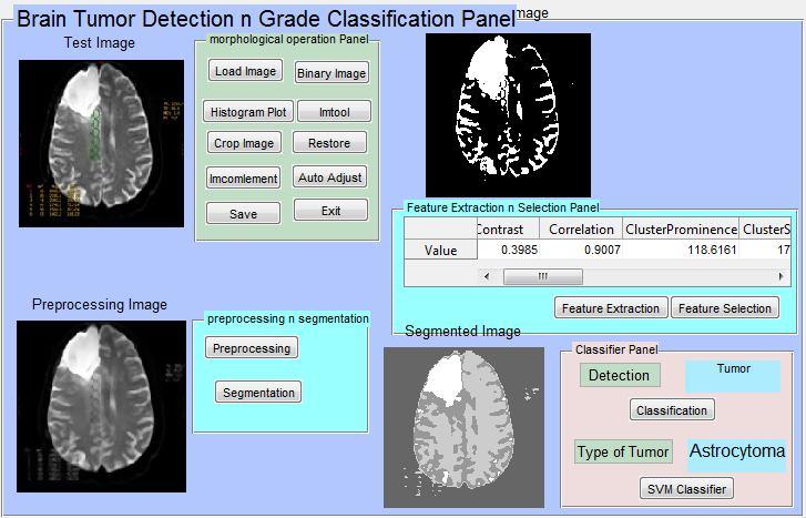 Astrocytoma etc. SVM classifier has been used to determine whether it is normal or abnormal [11]. SVM is a binary classification method in which two classes for input data has been fixed.