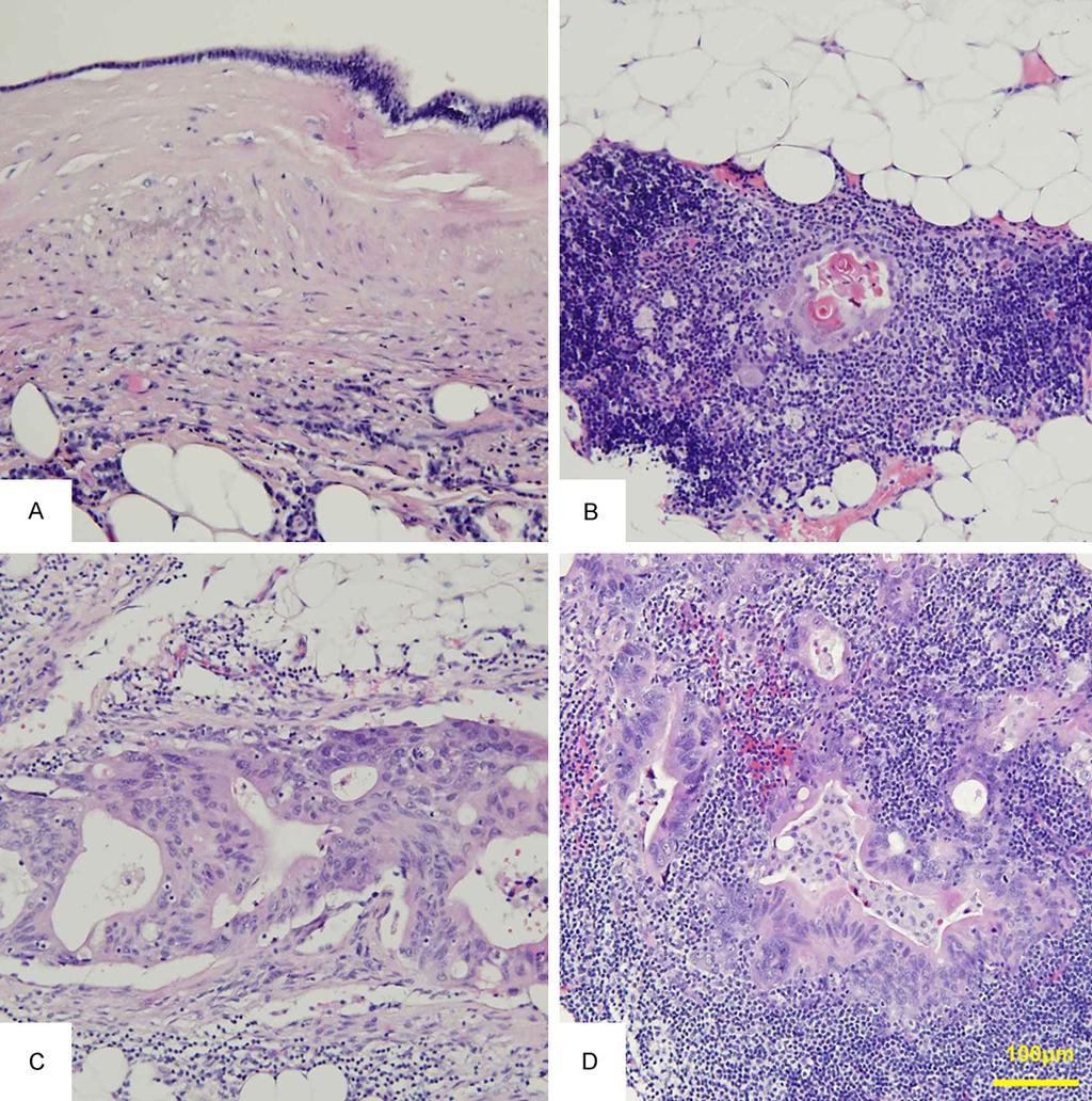 Figure 2. Microscopic findings. (A) The lining consisted of flat to columnar epithelium. (B) Thymic tissue was seen around the wall of the cyst.