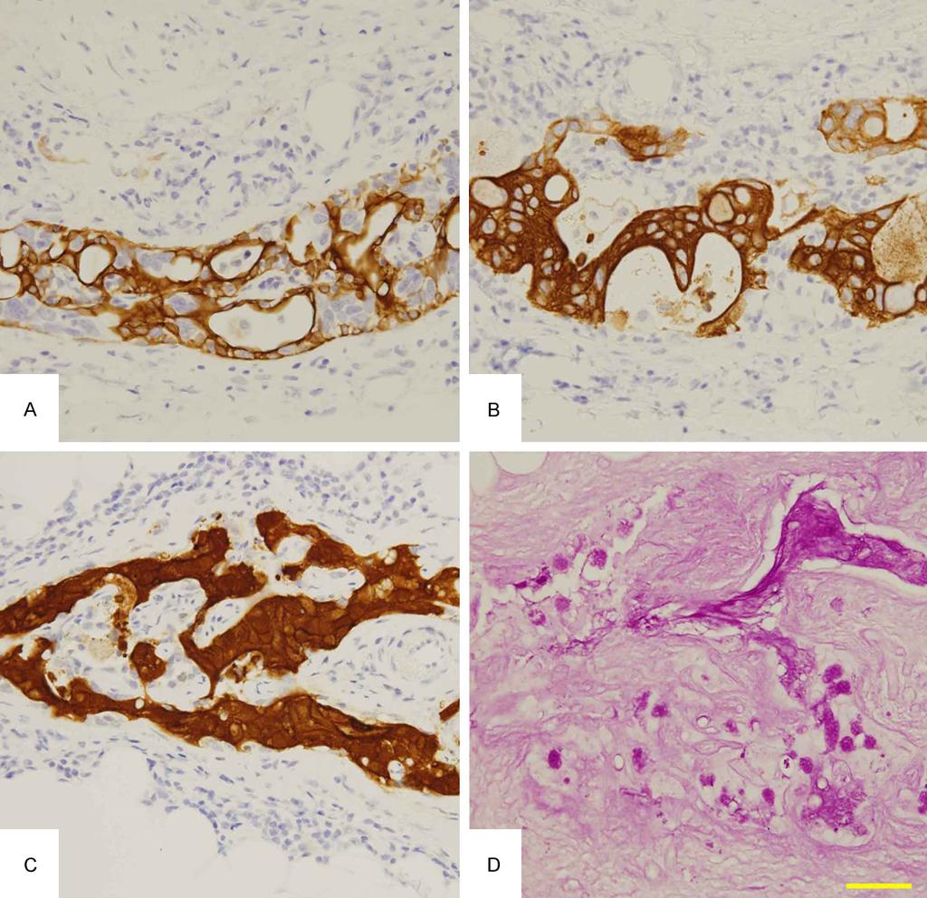 Figure 3. Immunohistochemical and PAS stains. The immunhistochemical stains reveal strong positivity for cytokeratin (CK) 7 (A), CK20 (B) and Villin (C).