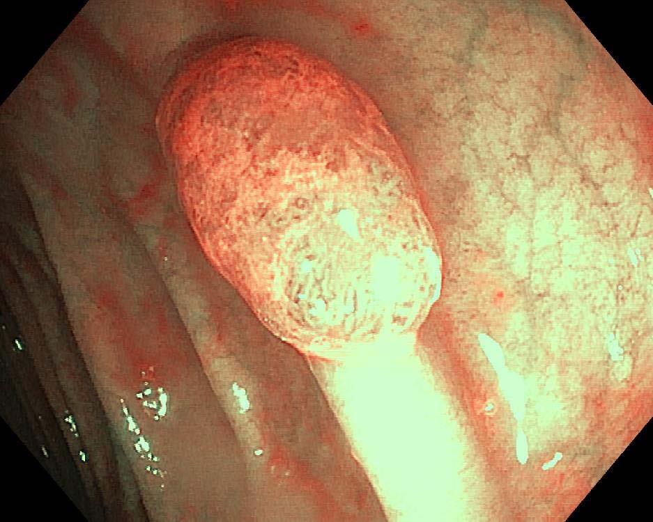 Smoking is also an important risk factor for the development of these polyps.