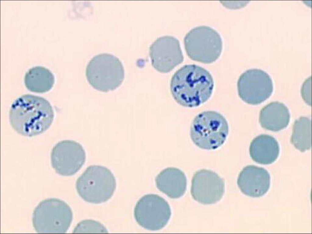 Reticulocyte count the youngest red cells in the circulation, identified by the presence of residual RNA normal; 1.