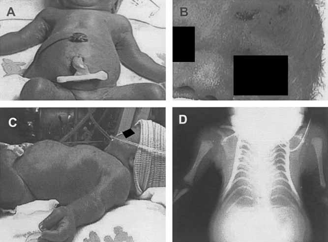 Paternal UPD14 syndrome Clinical features Approx 30 patients reported Polyhydramnios Premature labour Skeletal abnormalies Usually early death Chu et al AJMG 2003 Figure 1. The patient as a neonate.