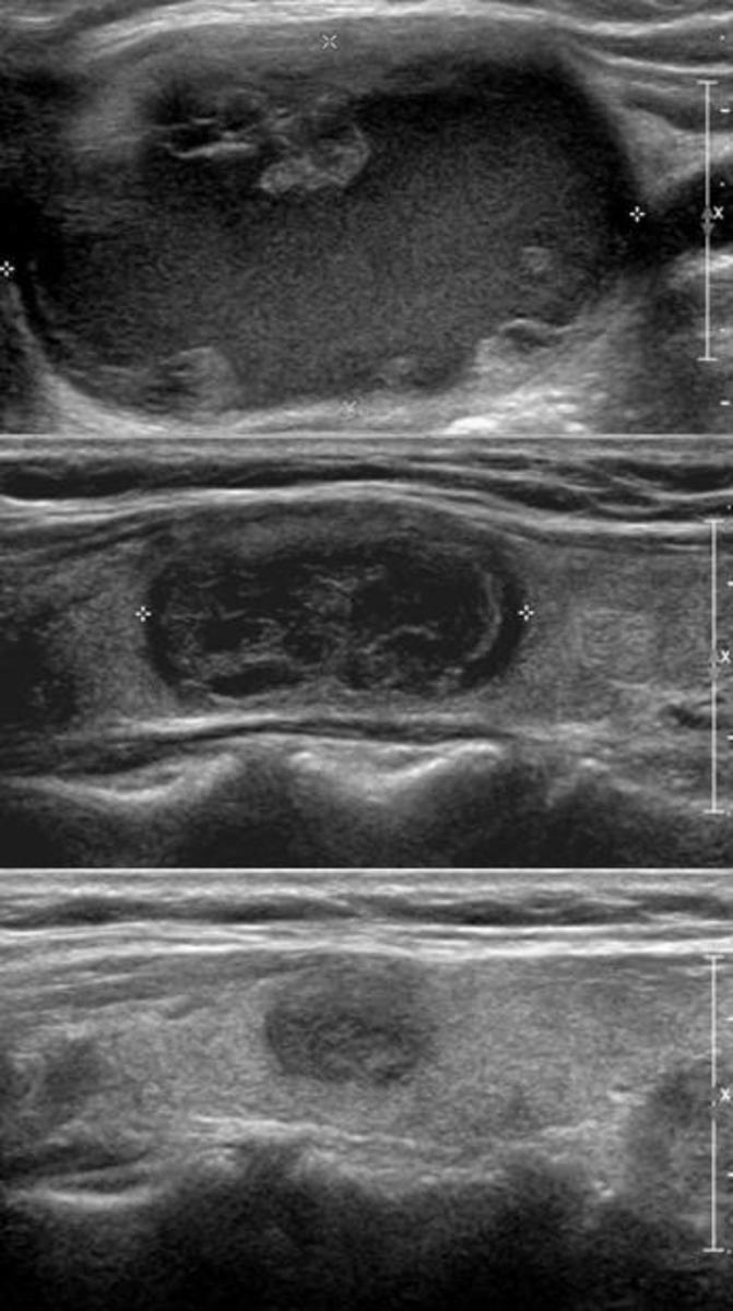 Fig. 2: A case of moderate aspiration with successful result after initial ultrasound (US)- guided percutaneous ethanol ablation (EA) in a 54-year-old woman.