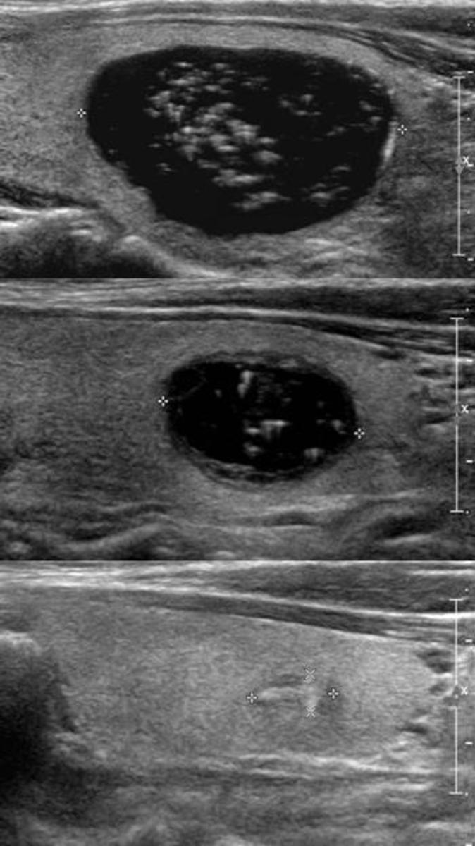 Fig. 3: A case of scant aspiration with unsuccessful result after initial ultrasound (US)- guided percutaneous ethanol ablation (EA) in a 44-year-old man.