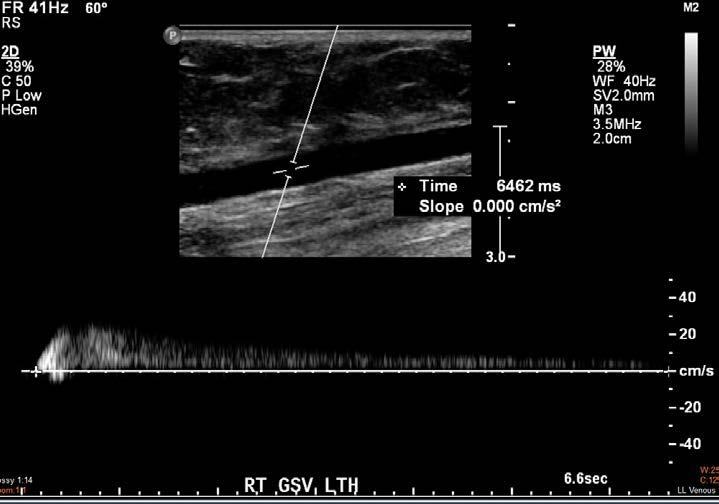 The retrograde flow in the lower thigh GSV lasts over 6.4s. The diameter at this level is 4.9mm.