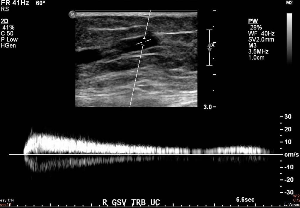 A calf tributary uniting with the reflux GSV in the