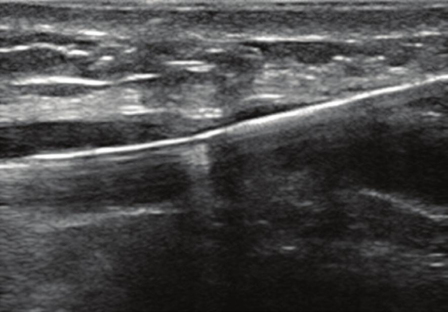 However, this principle is commonly disregarded in lower extremity DVT when popliteal vein access is used in the presence of thrombus extending into the tibial veins.