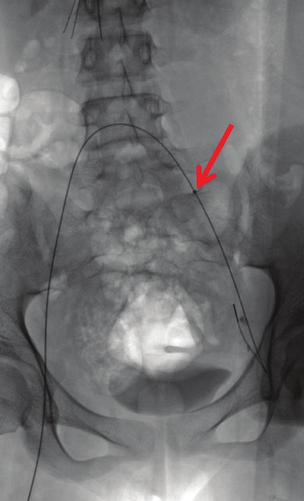 Figure 5. Up-and-over access in preparation for thrombolysis of left iliac vein thrombus. The tip of the sheath (arrow) inserted from the right can be seen in the left CIV.