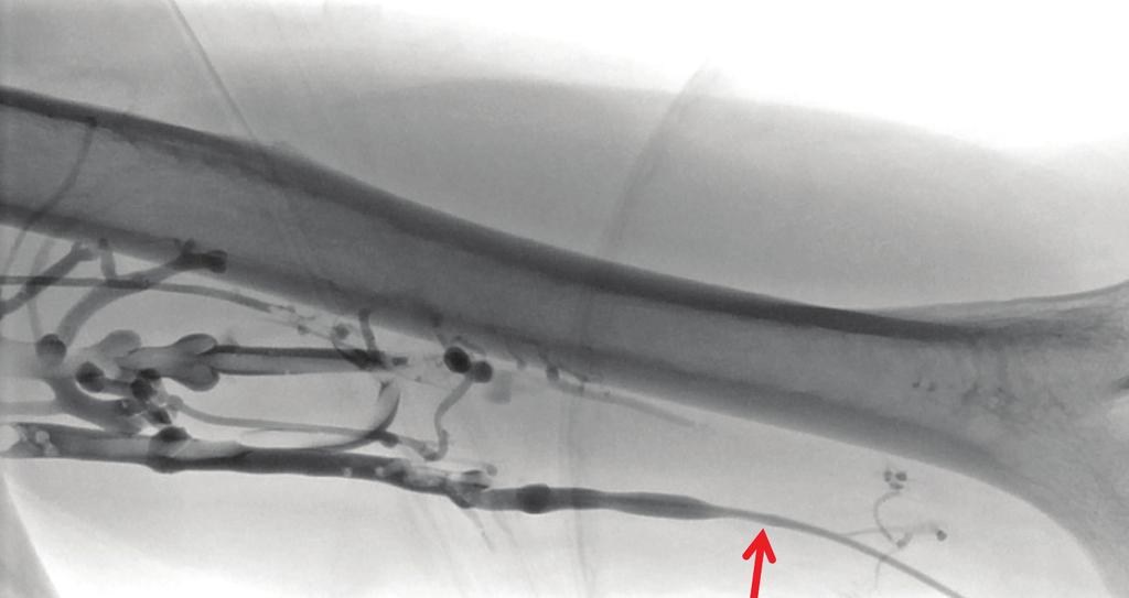 Figure 8. Spot image of a left upper arm venogram after access of the basilic vein (arrow) low in the arm, showing thrombus in the basilic and brachial veins.