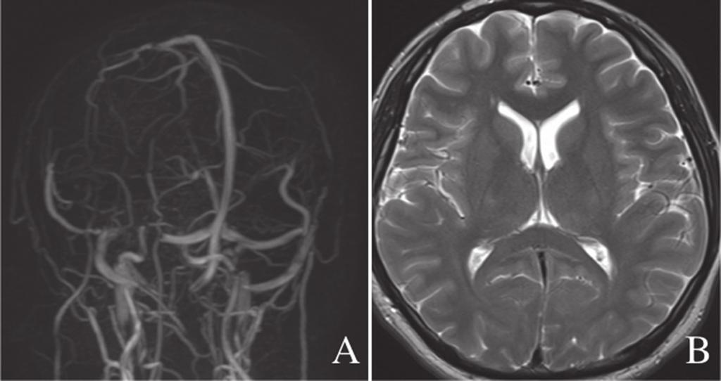 Yamaguchi R, et al. Fig. 1 (A) MR venography. Flow gaps were observed in the right transverse and occipital sinuses, indicating severe stenosis. (B) T2-weighted image.