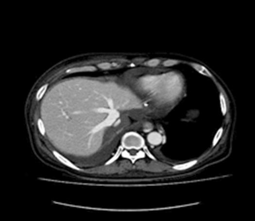 During total hepatectomy of the recipient patient with preservation of the native retrohepatic vena cava, we paid particular attention not to injure the IVC, but the suprahepatic portion received a