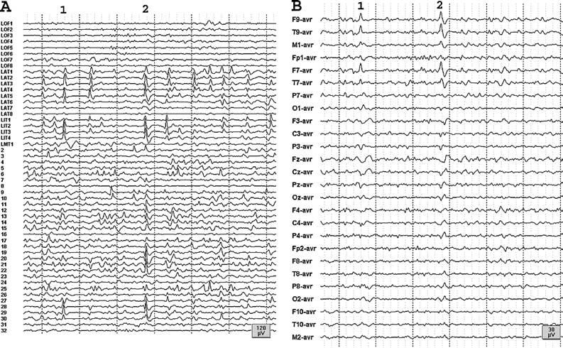 EEG SUBSTRATES OF INTERICTAL SPIKES 671 FIG. 3. A: Intracranial EEG recording demonstrates a heterogeneous population of interictal spikes. B: Simultaneous scalp EEG recording.