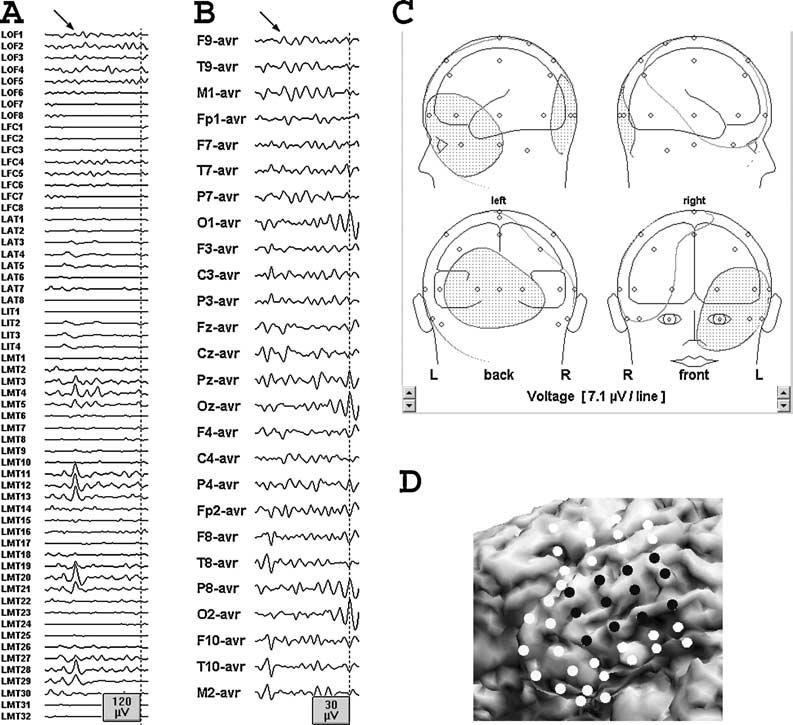 672 J. X. TAO ET AL. FIG. 4. Simultaneous intracranial (A) and scalp (B) EEG recording of a left temporal spike (indicated by arrow). No scalp potential is evident from this cortical source.