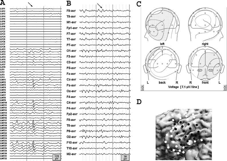 EEG SUBSTRATES OF INTERICTAL SPIKES 673 FIG. 5. Simultaneous intracranial (A) and scalp (B) EEG recording of a left temporal spike (indicated by arrow).