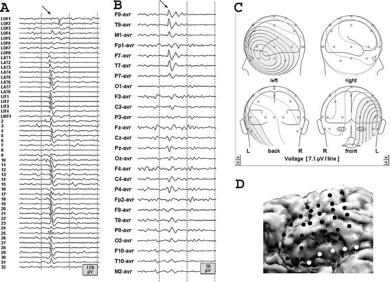 EEG SUBSTRATES OF INTERICTAL SPIKES 675 FIG. 7. Simultaneous intracranial (A) and scalp (B) EEG recording of a left temporal spike (indicated by arrow).