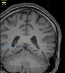 Case Example 32 year old RH man Seizures: déjà vu aura, dialeptic, automotor Etiology: unknown (imaging