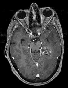 Case Example 57 year old RH woman Seizures: