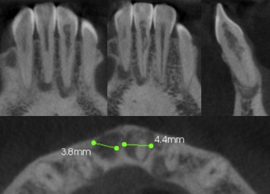 one lesion also in the anterior sextant with a well defined radiopacity at the apex. Texture is ground glass -B: radiopacities are seen at the apices of the molars.