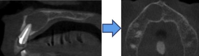 vital) -If a PRIO, would be a radicular cyst due to size and tooth being previously RCT ed -KCOT would also be on the differential (commonly in maxillary canine/lateral area) -Represents 3