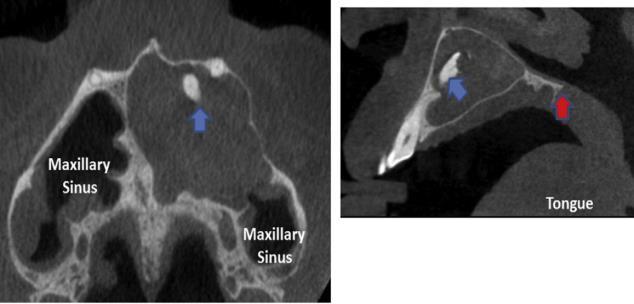 midline to first molar site -Displaced and eroded anterior wall of the maxillary sinus -Infiltrating the lumen of the sinus -B-L expansion is half of M-D expansion -Unerupted tooth is seen (blue