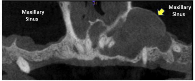 maxilla due to thin bone and less cortical bone -Although this is KCOT, it may present with large B-L expansion in the softer maxillary bone -Mean presentation age is 38 years -Used to be called
