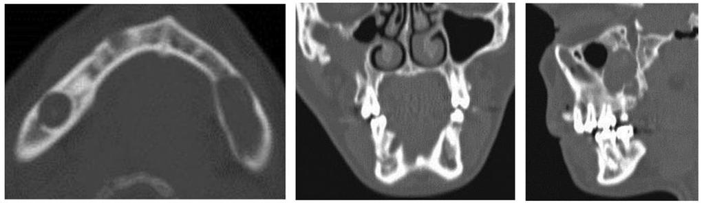 Nevoid basal cell carcinomas -Left is axial view, middle is coronal view, right is sagittal view -Lateral wall of sinus in coronal view: missing bone due to biopsy taken prior to radiograph -Multiple