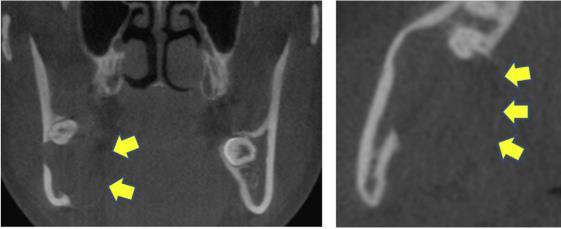 Ameloblastoma -Coronal and axial reconstruction of a CBCT -Unicystic ameloblastoma -Eroded lingual cortex is visible -Extension