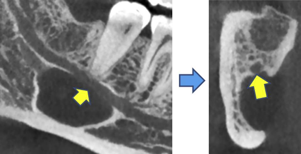 Lingual bone defect (Stafne s bone cyst) -Must weaken the mandible, but no pathologic fractures have been reported -Likely because it is mostly found in older adults (~50), who rarely participate in