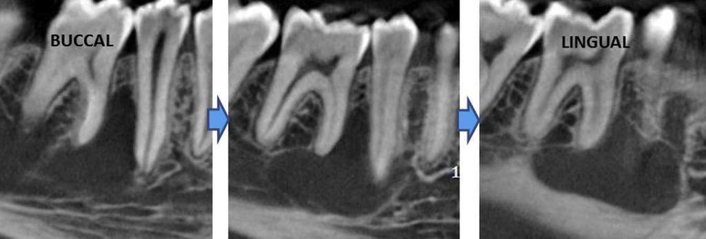 cortex Simple bone cyst (traumatic, idiopathic, hemorrhagic bone cyst) - Panoramic reconstruction of a CBCT -No displacement, resorption -Scalloped borders -Happens mostly in children, possibly