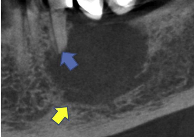 Glandular odontogenic cyst -Poorly defined unilocular RL -Root resorption of the 5 -Some B-L expansion -IAN displaced inferiorly (yellow arrow), basal process affected -Superior cortex