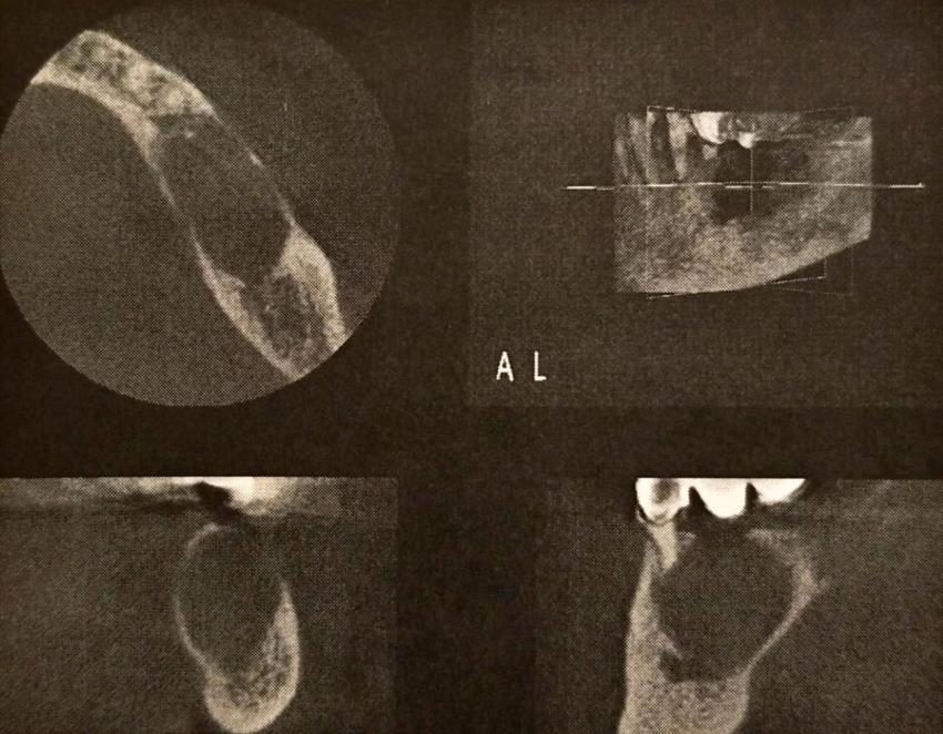 collection of unidentified lesions -Multilocular + root resorption should be treated as if it were neoplastic -90% have swelling, 33% with pain, 15% with numbness -Varies from unilocular