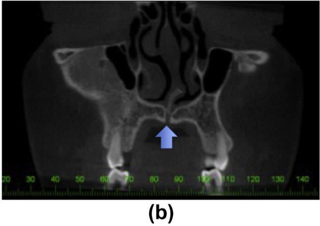 nasopalatine duct -Dx: monostotic fibrous dysplasia -Radiopacity resembling ground glass seen on mandible, maxilla, zygoma, and sphenoid -Maxillary