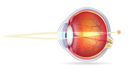 NEARSIGHTEDNESS People with nearsightedness typically see close objects more clearly than objects farther away, which appear blurry.